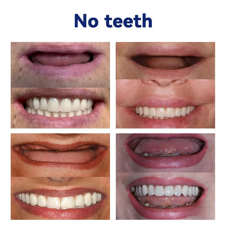 Hermsa®-🦷Advanced Customized Full Denture Set🦷 (⏰Limited time discount last 30 minutes⏰)