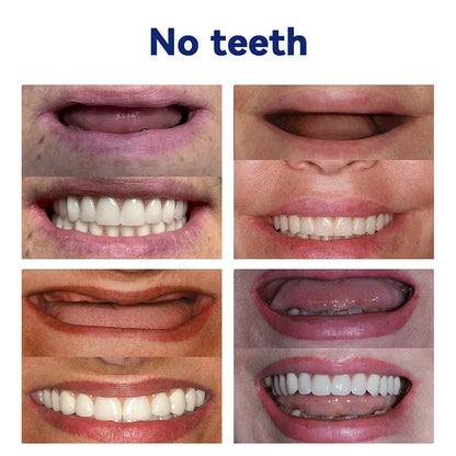 Hermsa®-🦷Advanced Customized Full Denture Set🦷 (⏰Limited time discount last 30 minutes⏰)